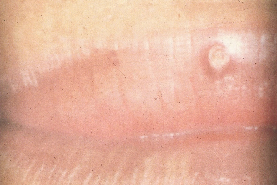 histología del molusco contagioso