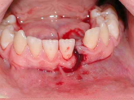 clasificación de fractura de mandíbula