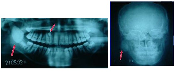 Osteoma de mandíbula: relato de caso