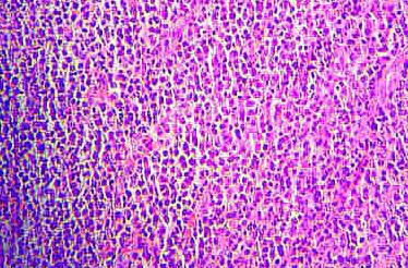 Figura 2. Plasmocitoma Solitario. Sábanas de Células plásmaticas atípicas. H/E x 40 hpf.