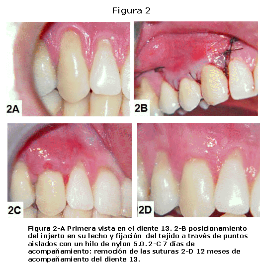 Recubrimiento De Las Recesiones Gingivales Con La Tecnica De Injerto Conjuntivo Subepitelial Asociado Al Deslizamiento Coronario Del Colgajo Relato De Caso Clinico