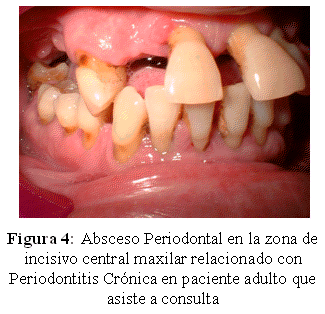 fístula de absceso periapical