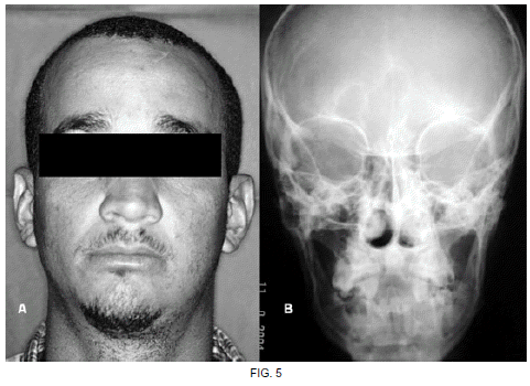 Osteoma de mandíbula: relato de caso