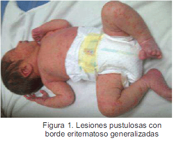 eritema tóxico neonatal