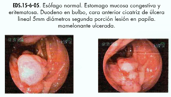 ampolla de vater histología