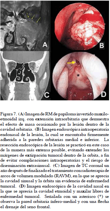 Papiloma nasal oncocitico - bijuterii-anca.ro - Papiloma nasal oncocitico