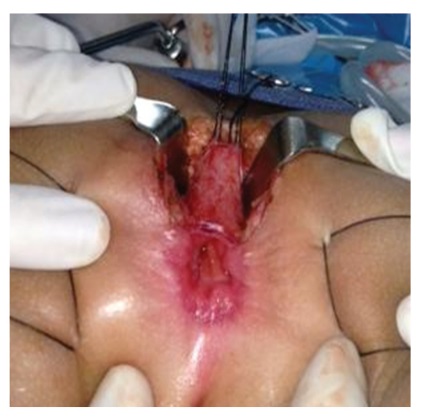 Av Fistula Revision Hot Sex Picture