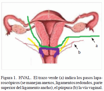 Histerectomia Laparoscópica