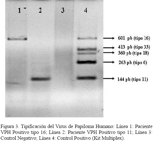 Genotipificación Del Virus De Papiloma Humano En Pacientes Con ...