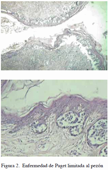 Enfermedad de paget de la mama reporte de 13 casos