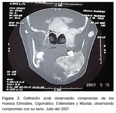 displasia fibrosa maxilar