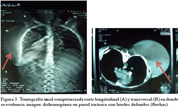 Histiocitoma fibroso maligno pleomórfico: Presentación de un caso y ...