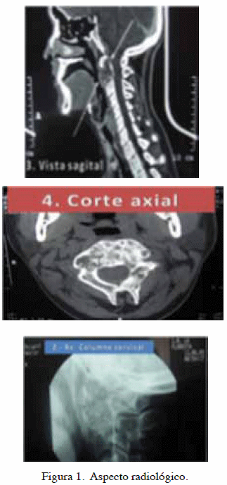 Quiste óseo Aneurismático Simulando Tumoración De Rinofaringe