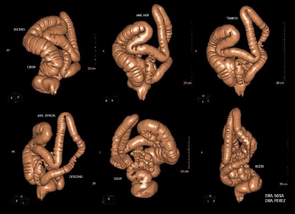 Posprocesamiento de imágenes tomográficas de colon para diagnosticar ...