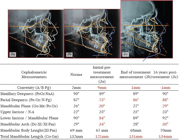 Prediction of the individual response to treatment of skeletal Class II ...