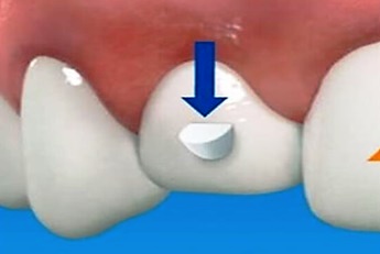 Power Ridgesz Tratamiento odontológico de Invisalign en pacientes adultos