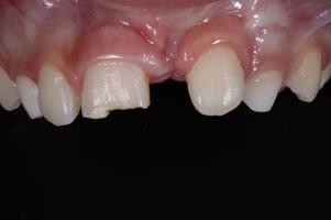 Restoration of fractured anterior tooth with monochrome composite resin ...