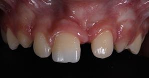 Restoration of fractured anterior tooth with monochrome composite resin ...