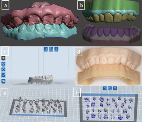 Rehabilitación oral utilizando coronas impresas en 3D para amelogénesis ...
